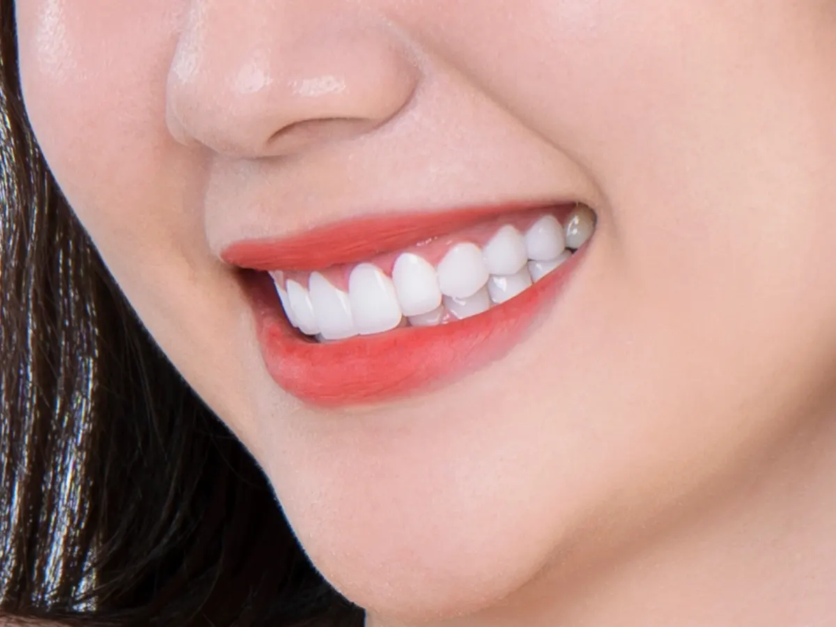 Bọc sứ nguyên hàm mang lại một diện mạo nụ cười hoàn toàn mới